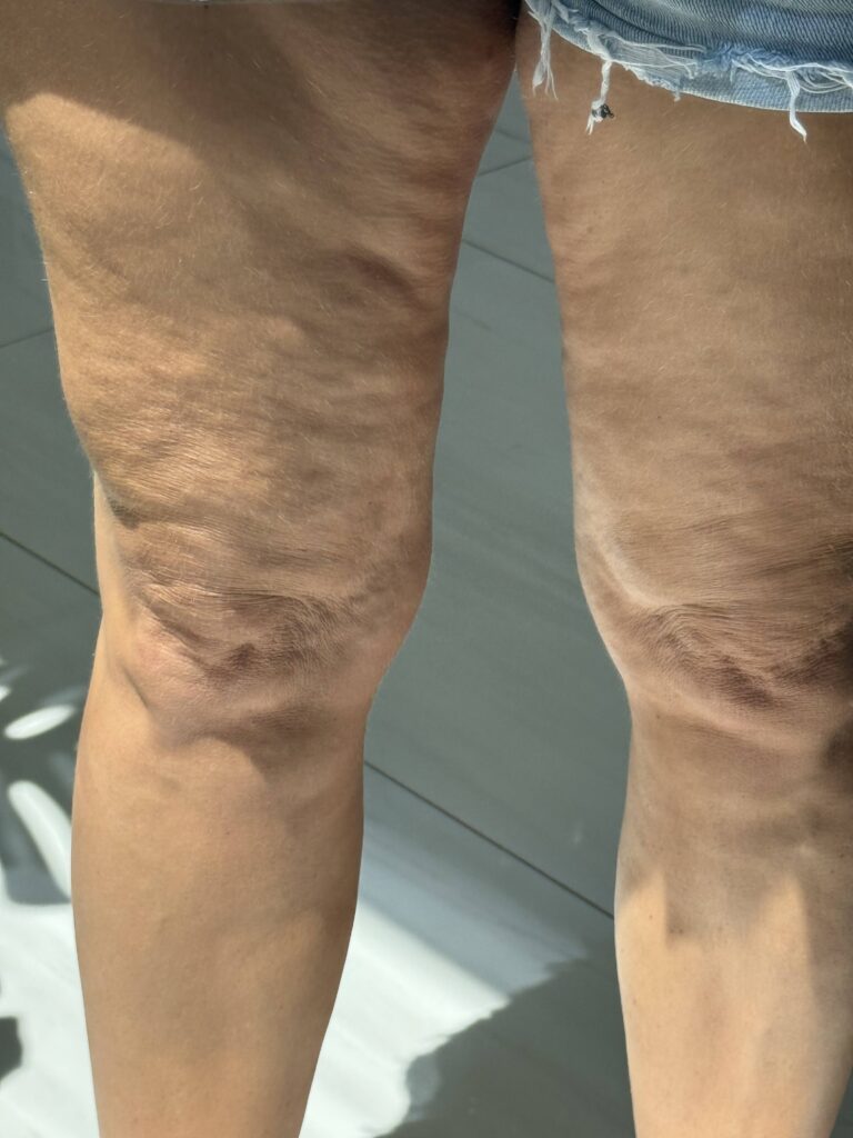 Beine mit sichtbarer Cellulite an den Oberschenkeln
